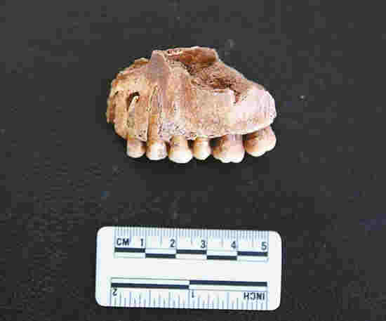 牙周病、根尖膿腫、牙結石