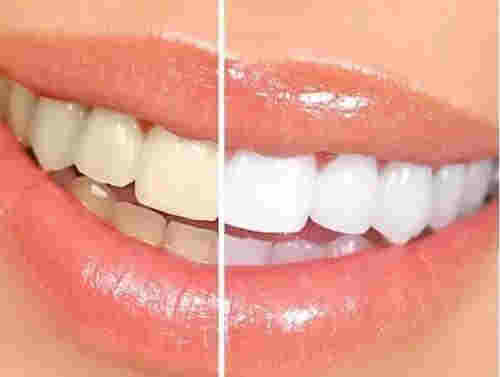 悅刻電子煙會讓牙齒變黃嗎？